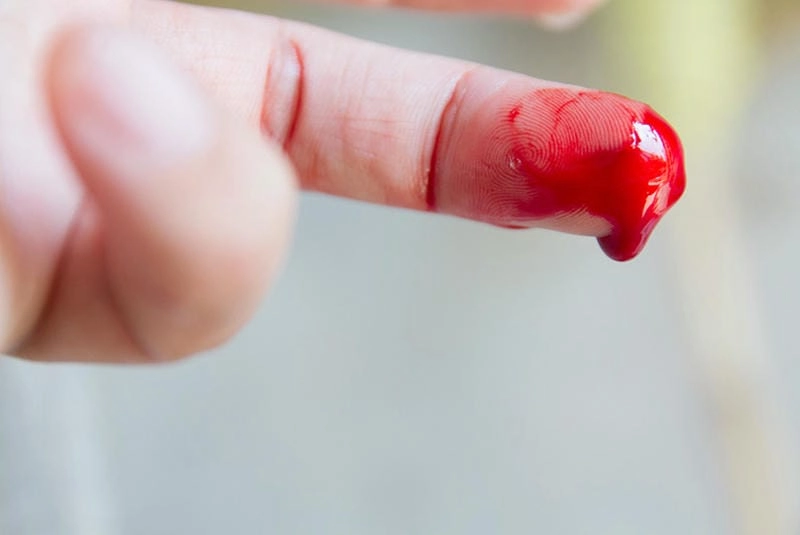 Choáng với hình ảnh người bị bệnh máu khó đông