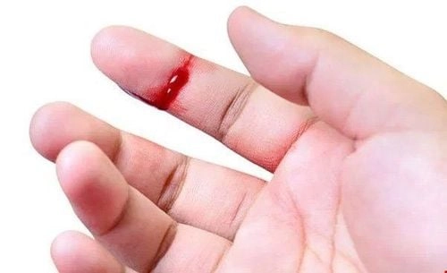 Cảnh báo từ hình ảnh người bị bệnh máu khó đông