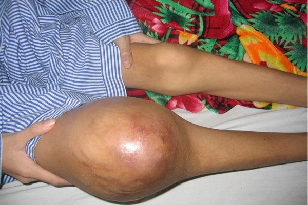 Rùng mình trước ảnh bệnh máu khó đông chân thực