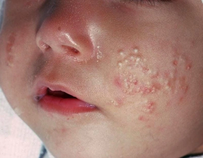 Xem rõ hình ảnh bệnh mụn trứng cá thực tế