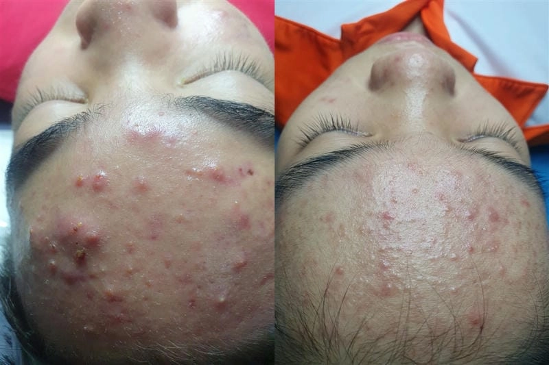 Khám phá hình ảnh bệnh mụn trứng cá chi tiết