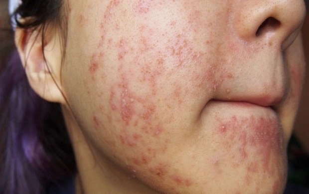 Tham khảo hình ảnh người bị bệnh mụn trứng cá chi tiết