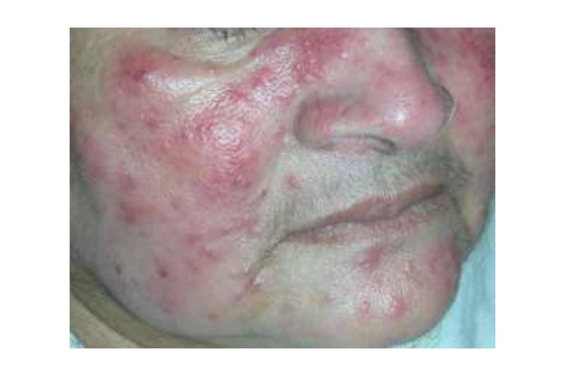 Nguyên nhân khiến mặt bị mụn trứng cá lâu lành