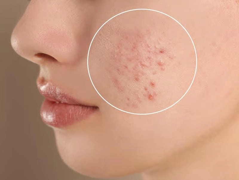 Cách xử lý mụn trứng cá đầu trắng an toàn