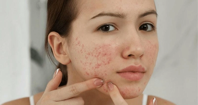 Chia sẻ khi da mặt bị mụn trứng cá nghiêm trọng