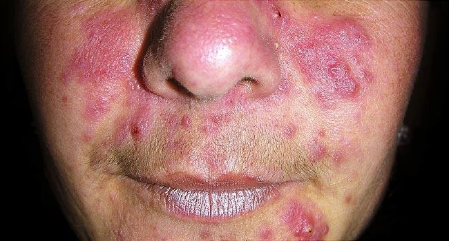 Phân biệt và xử lý mụn trứng cá bọc đúng cách