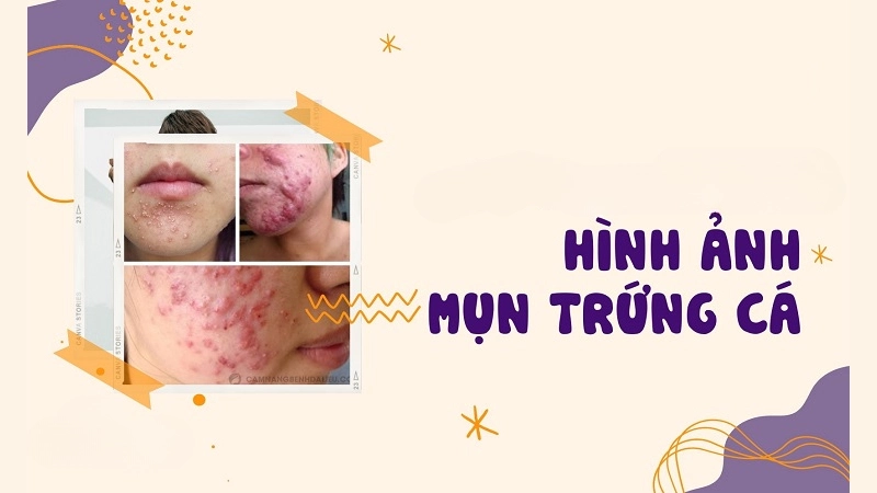 Mụn trứng cá là như thế nào mà khiến ám ảnh đến thế