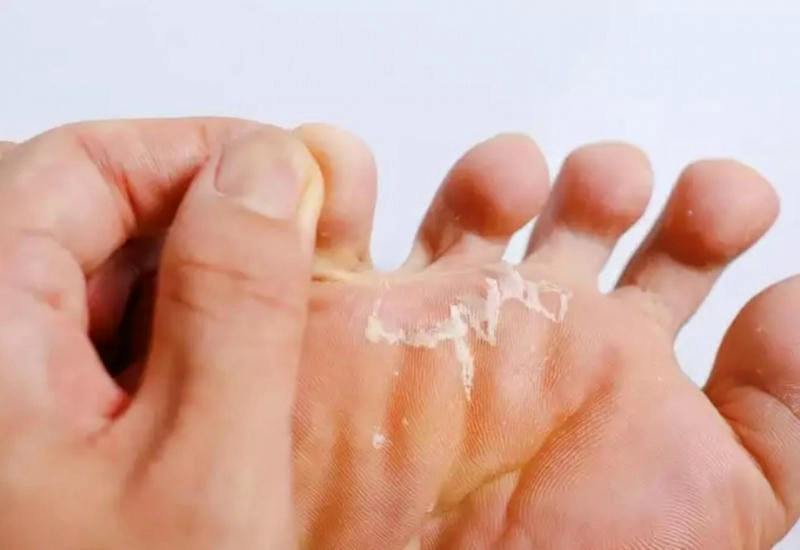 Hình ảnh nấm da chân hay gặp khi mang giày bí hơi