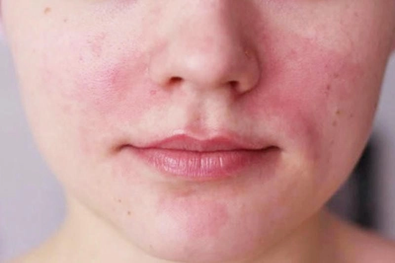 Nhận biết hình ảnh nấm da mặt qua tổn thương vùng má