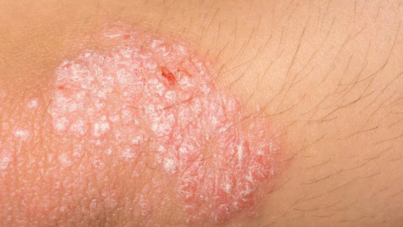 Hình ảnh bệnh nấm bìu gây ngứa rát nhiều