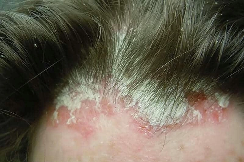 Phân biệt tình trạng với các ảnh nấm đầu rõ ràng chi tiết