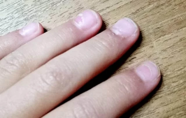 Cảnh báo sớm từ hình ảnh nấm móng tay ở trẻ nhỏ