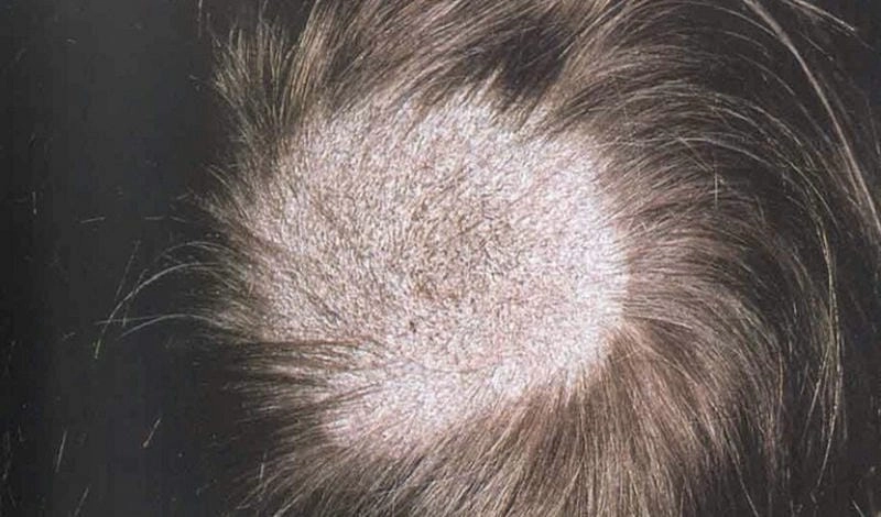 Nhận biết nhanh qua các ảnh nấm da đầu thực tế rõ ràng