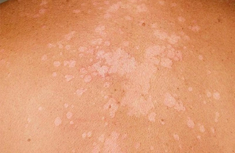 Hình ảnh nấm da toàn thân gây ngứa và tróc vảy khắp người
