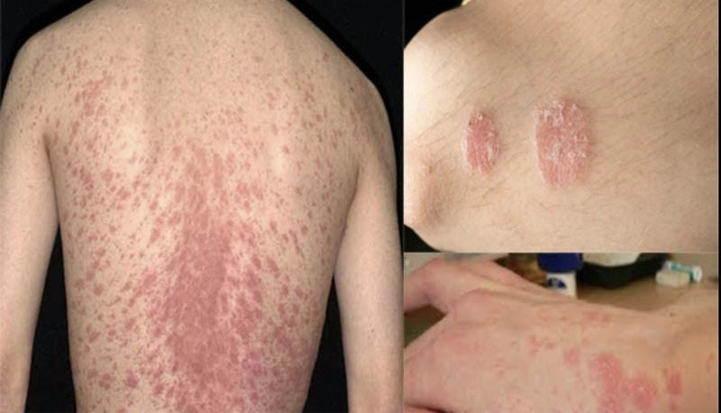 Hình ảnh các loại nấm da thường gặp với biểu hiện khác nhau