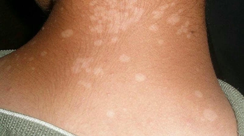 Hình ảnh bị nấm da thường có vết đỏ tròn ngứa và bong tróc