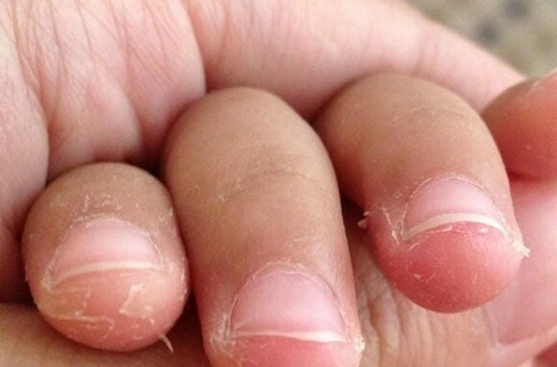 Hình ảnh ngón tay bị nấm gây khô rát và nứt da quanh móng