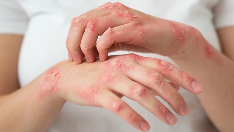 Tổng hợp hình ảnh bệnh nấm da tay và dấu hiệu ban đầu