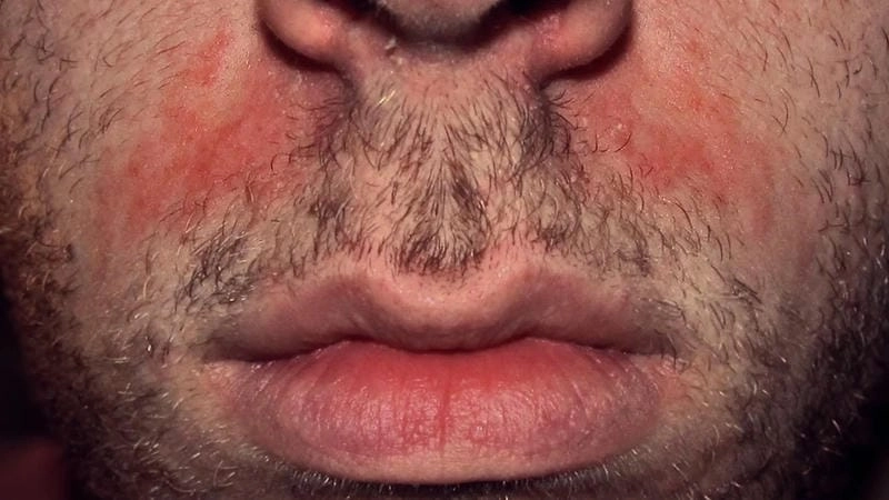 Cảnh báo từ hình ảnh bệnh nấm ở nam giới phổ biến hiện nay