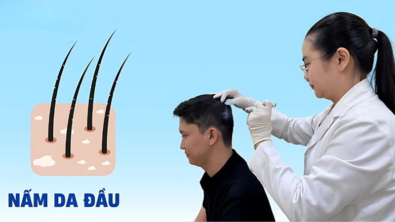 Hình ảnh bệnh nấm da đầu là như thế nào