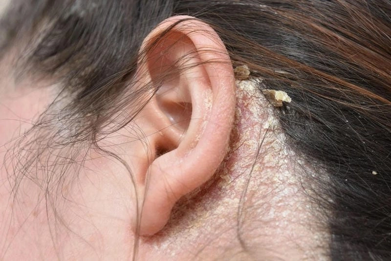 Cảnh báo sớm với hình ảnh bị nấm đầu thường gặp