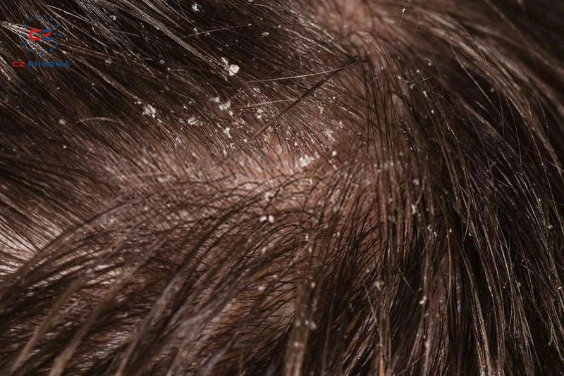 Dấu hiệu nhận biết hình ảnh đầu bị nấm nguy hiểm