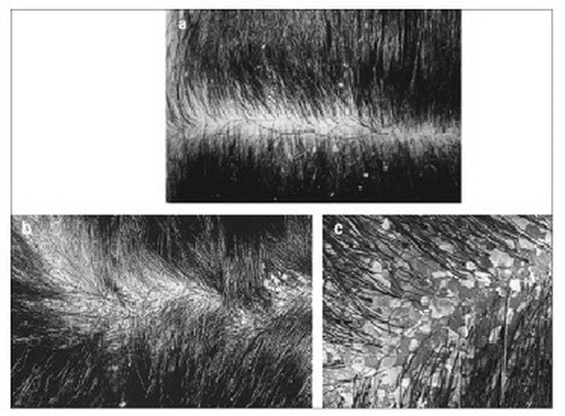 Cách nhận biết hình ảnh nấm da đầu nhẹ ban đầu