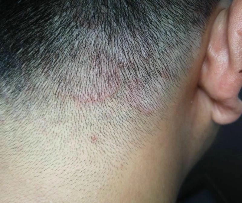 Tìm hiểu hình ảnh bệnh nấm da đầu chi tiết dễ nhận biết