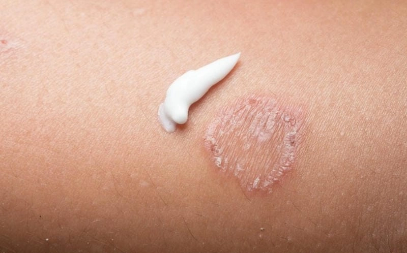 Tham khảo nhanh bộ ảnh bệnh nấm da mặt thực tế