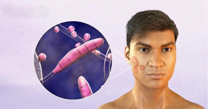 Xem rõ triệu chứng qua ảnh bị bệnh nấm da mặt