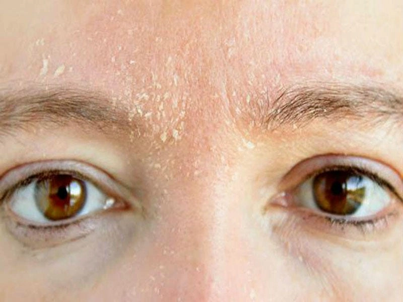 Tổng hợp hình ảnh bị bệnh nấm da mặt để so sánh