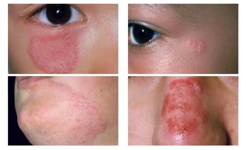 Cập nhật hình ảnh người bị bệnh nấm da mặt mới nhất