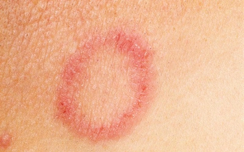 Mẹo dân gian cách trị nấm da mặt tại nhà an toàn