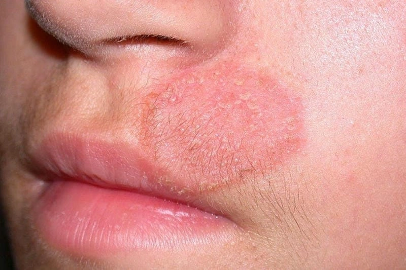 Tìm hiểu nguyên nhân da mặt bị nấm ngứa thường gặp