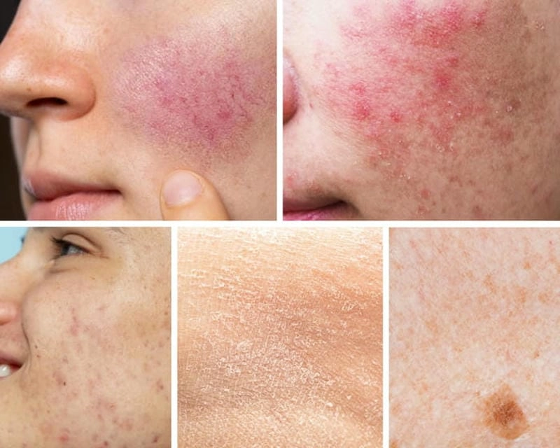 Nhận biết các dấu hiệu nấm da mặt dễ bỏ sót