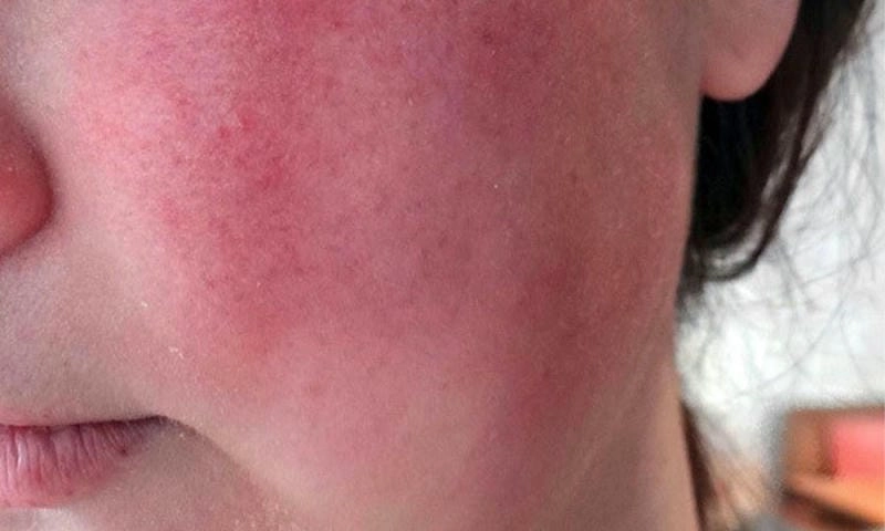 Giải thích rõ hiện tượng nấm da mặt thường thấy