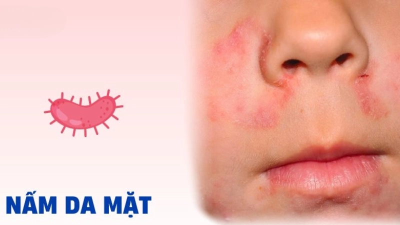 Hình ảnh bệnh nấm da mặt là như thế nào