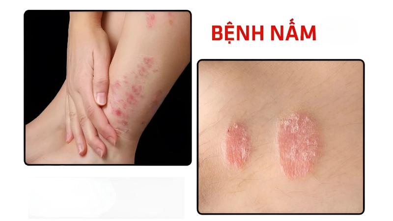 Hình ảnh bệnh nấm là như thế nào