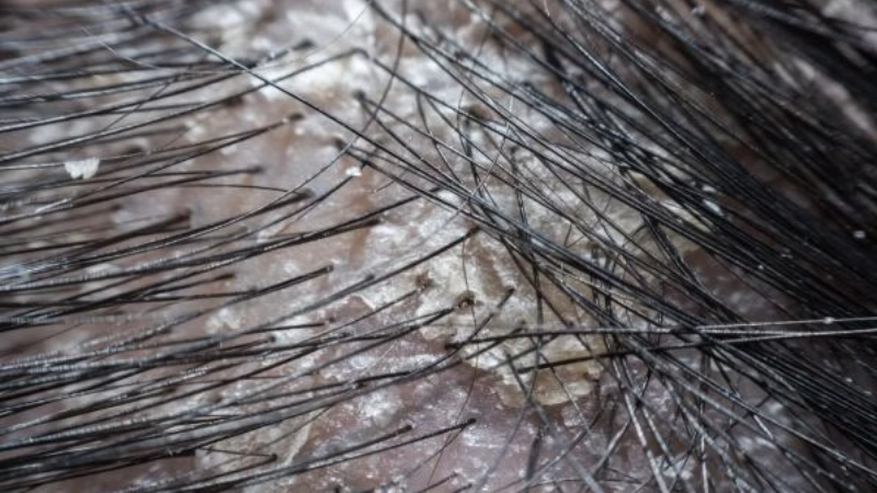 Tìm hiểu hình ảnh da đầu bị nấm để nhận biết sớm