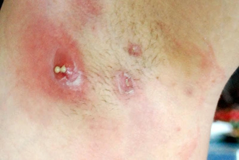 Khám phá hình ảnh bệnh ổ gà ở nách dễ nhận biết