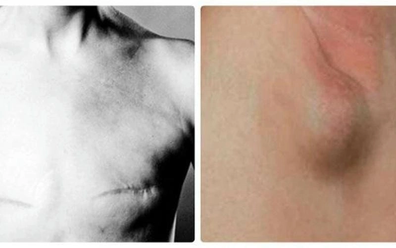 Nguyên nhân thường gặp khiến bạn bị ổ gà ở nách