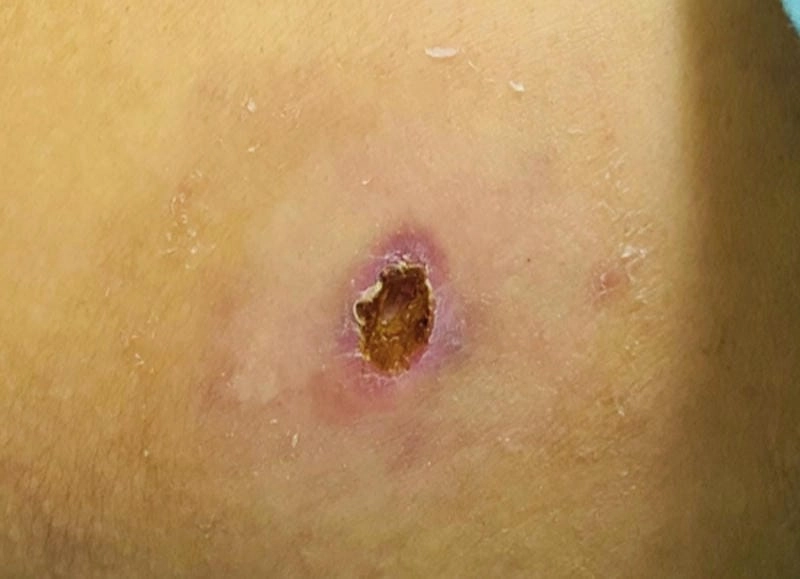 Hướng dẫn an toàn về cách chữa ổ gà ở nách hiệu quả