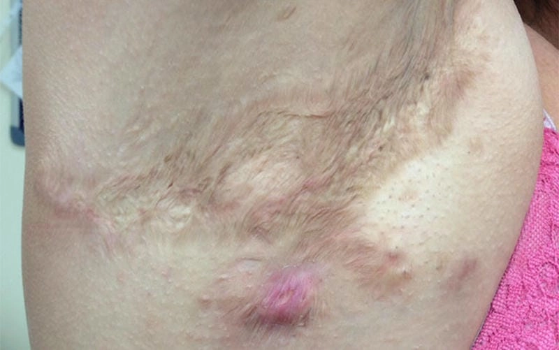 Tổng hợp nhanh các mẹo chữa ổ gà ở nách phổ biến