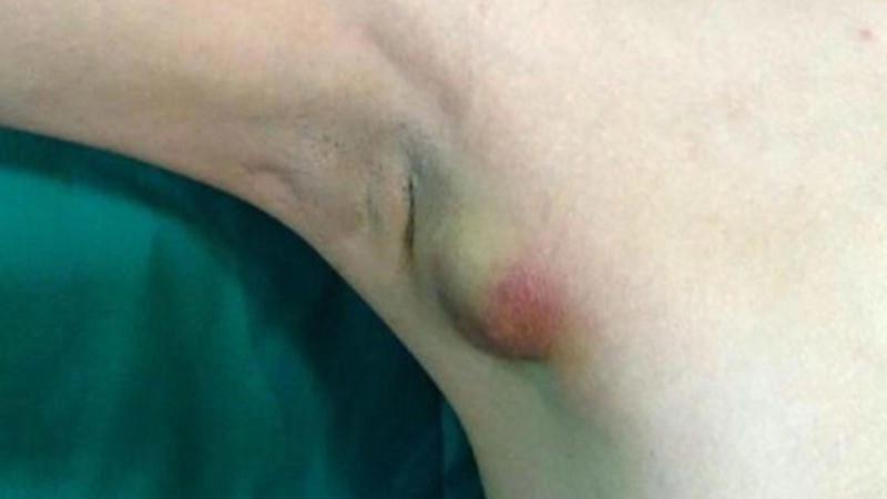 Dấu hiệu điển hình của viêm nang lông nách mụn ổ gà ở nách