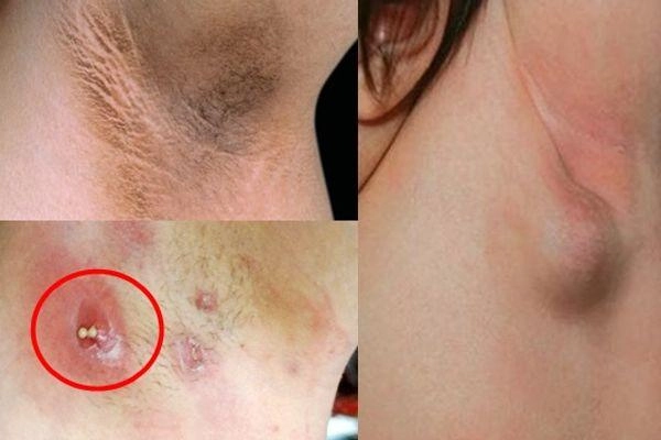 Quan sát trực quan ảnh người bị bệnh ổ gà ở nách thực tế