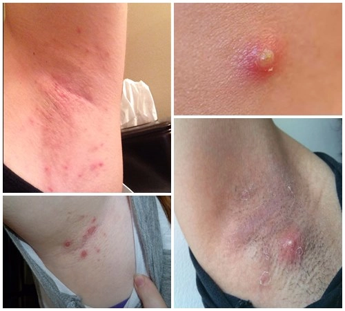 Phân biệt triệu chứng của nạch bị bệnh ở gà và nách