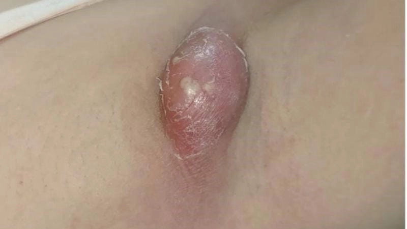 Tìm hiểu rõ hơn về hình ảnh bệnh ổ gà phổ biến