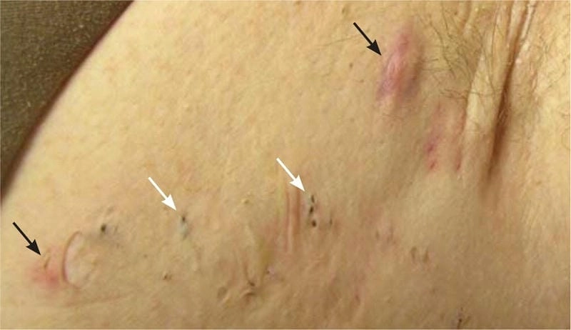 Triệu chứng điển hình của bệnh ổ gà ở nách dễ thấy