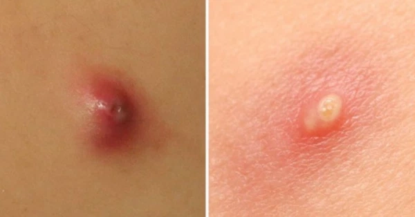 Hình ảnh bệnh ổ gà ở nách là như thế nào gây sốc người xem