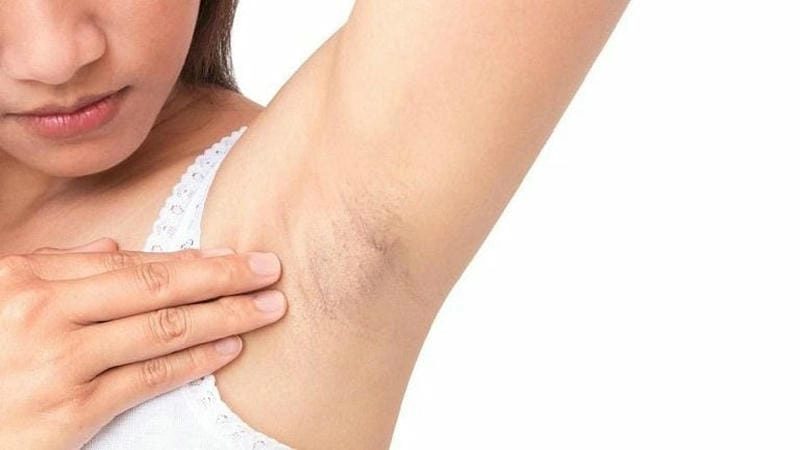 Hình ảnh thực tế mô tả rõ ổ gà ở nách hay gặp